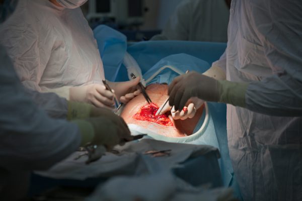 Женщине проводится операция кесарево сечение