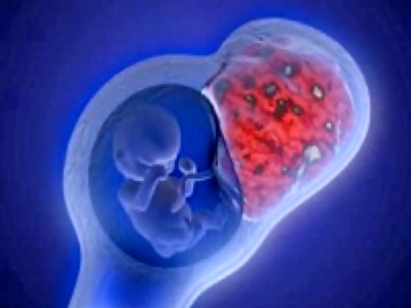 Влияние миомы матки на зачатие и вынашивание беременности