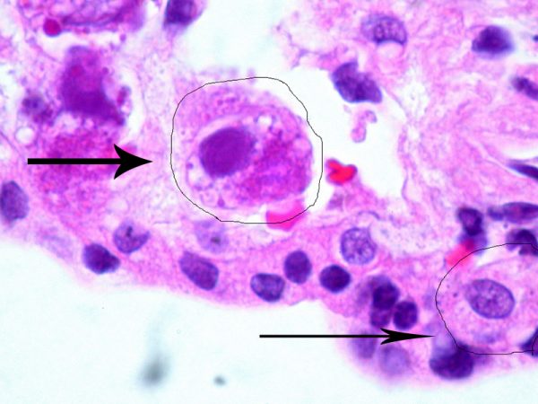 Клетки, поражённые цитомегаловирусом