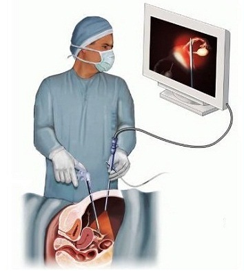Лапароскопическая операция при внематочной беременности