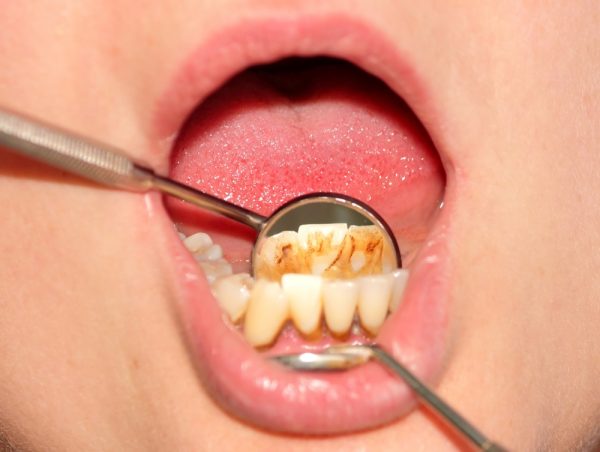 Стоматолог осматривает зубной налёт на зубах