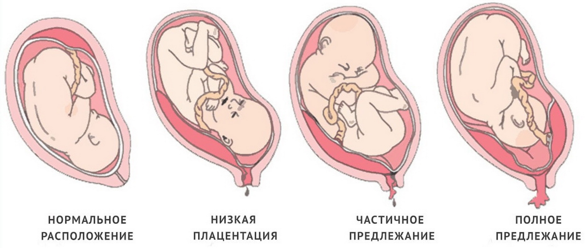 Полное предлежание при беременности. Краевое предлежание хориона 12. Краевое предлежание хориона 12 недель. Предлежание плаценты на 12 неделе беременности. Низкое прикрепление плаценты при беременности 21 неделя.