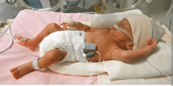 Недоношенный ребёнок в кувейзе на искусственной вентиляции лёгких