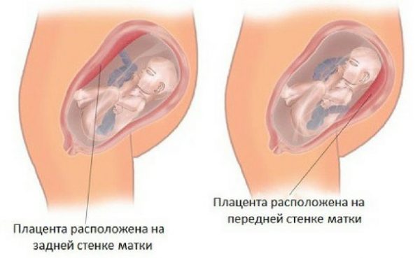 Расположение плаценты по задней и передней стенке матки