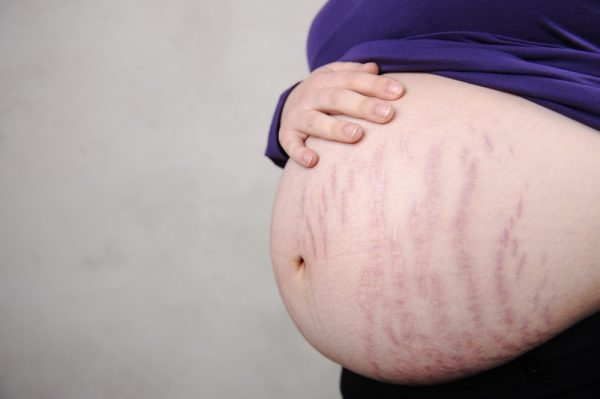 Растяжки кожи на животе беременной