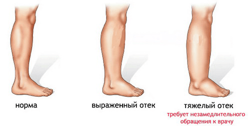 Разные степени отёков на ногах: рисунок