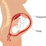 Схематическое изображение беременности с прикреплением плаценты по задней стенке