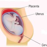 Схематическое изображение беременности с прикреплением плаценты в дне матки с указателями
