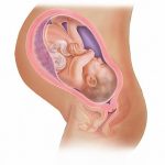 Схематическое изображение ребёнка в утробе с прикреплением плаценты по передней стенке