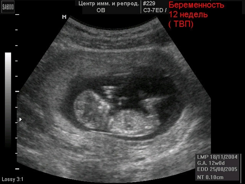 Беременность 12 4 недели
