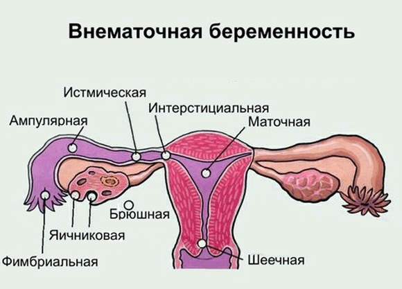 Виды внематочной беременности схематично