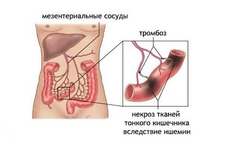 Тромбоз кишечника
