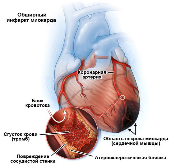 Развитие инфаркта миокарда