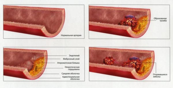 Развитие тромбофилии в артерии нижней конечности