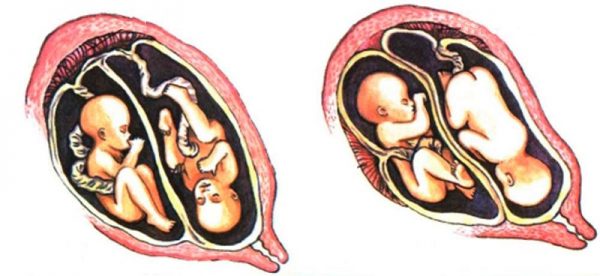 Однояйцевые и разнояйцевые близнецы в утробе