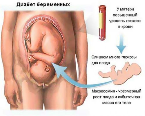 Схема расположения ребёнка в утробе матери