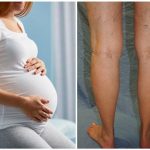 сидящая беременная, рядом женские ноги, поражённые варикозом