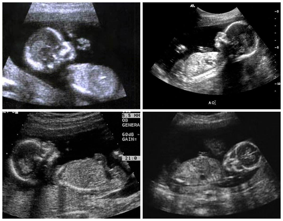 18 недель мальчик. 18 Недель беременности фото плода на УЗИ. УЗИ мальчика малыша на 18 неделе беременности. Малыш на 16 неделе беременности УЗИ. Малыш на 19 неделе беременности УЗИ.