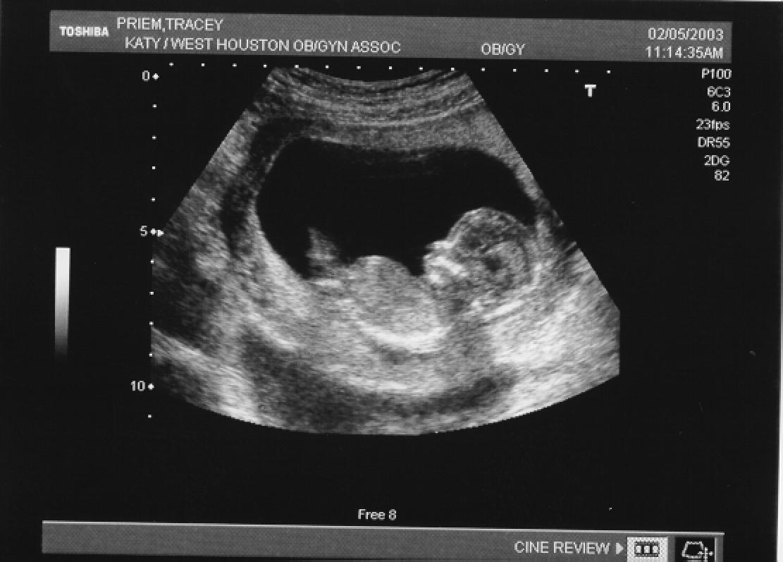 15 неделя беременности фото узи
