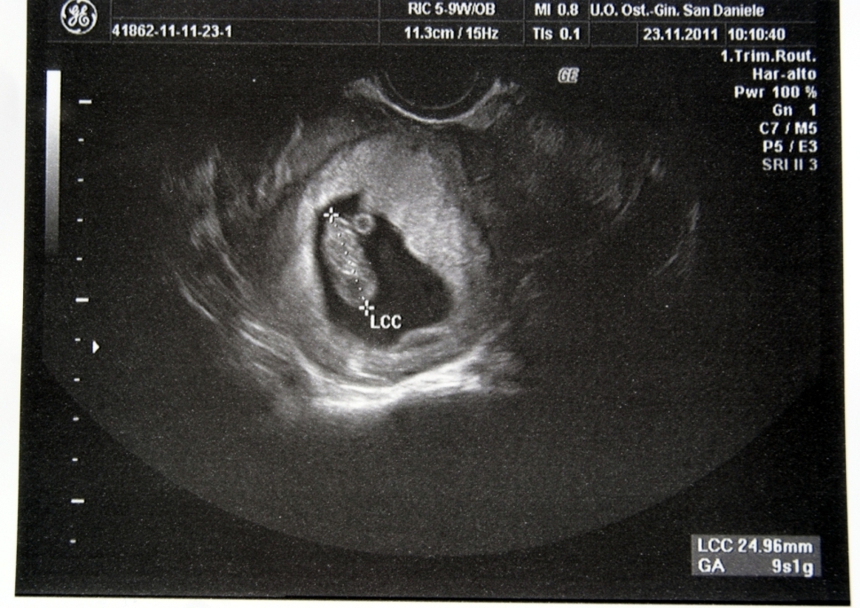 Пятая неделя ребенку. Эмбрион на 5 неделе беременности УЗИ. Ребёнок на 5 неделе беременности фото УЗИ. 5 6 Недель беременности фото эмбриона на УЗИ. 4 Недели беременности фото плода на УЗИ.