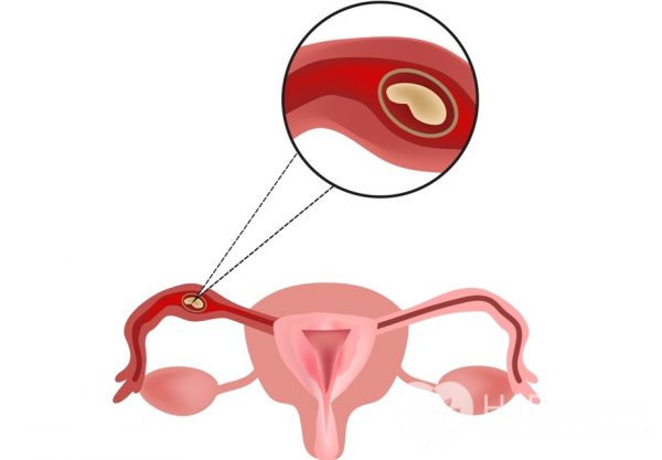 Пример трубной внематочной беременности