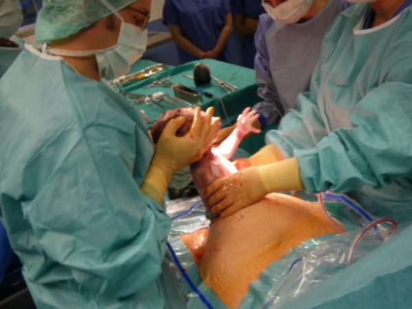 Врачи достают малыша во время операции кесарева сечения