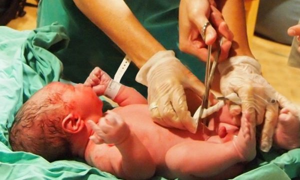 пуповину у новорождённого перерезают ножницами