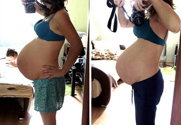 Живот беременной до и после опущения