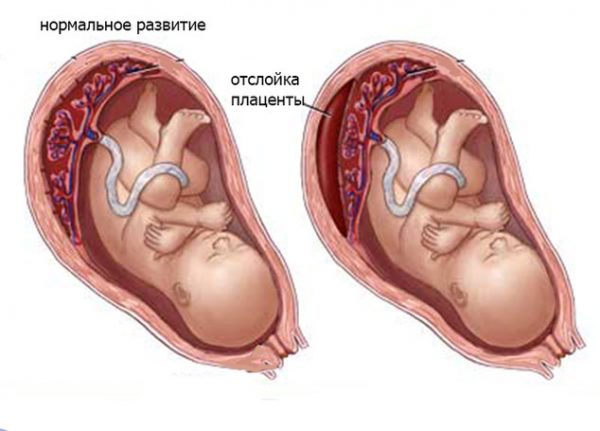 Сравнение нормального развития плаценты и её отслойка в рисунках