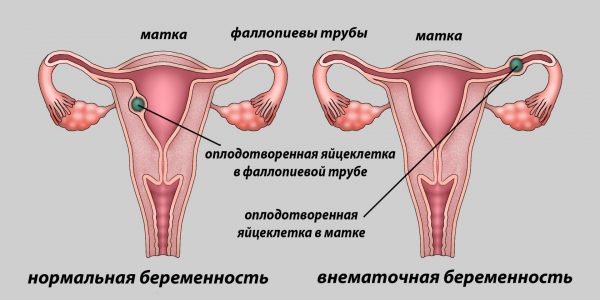 Иллюстрации нормальной и внематочной беременности