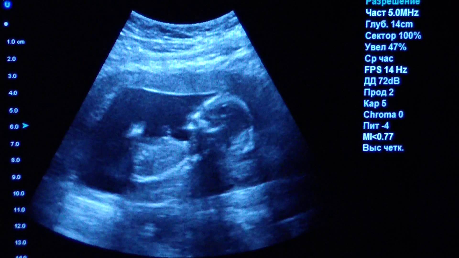 Узи 6 месяцев. Снимок УЗИ беременности 4 месяца. УЗИ 4 месяца беременности мальчик. УЗИ плода на 5 месяце беременности. УЗИ беременность на 2 месяца мальчик.