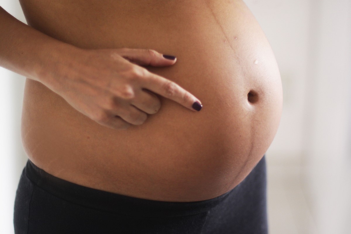 Тёмная полоска на животе во время беременности: причины возникновения и способы избавления