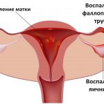 Воспаление матки, яичников и фаллопиевых труб