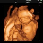 4Д УЗИ в 20 недель беременности