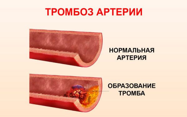 Изображение нормальной артерии и сосуда при повышенном тромбообразовании