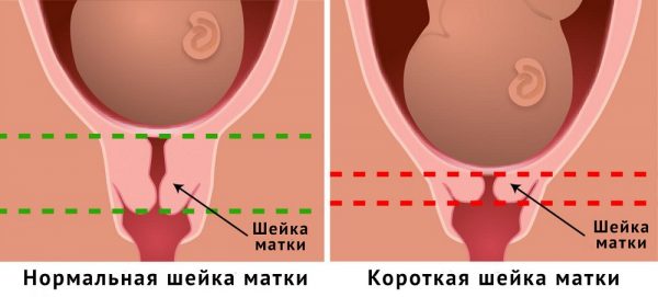 Нормальная и укороченная шейка матки при беременности
