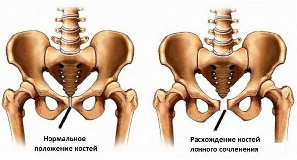 Нормальное положение костей симфиза и их расхождение