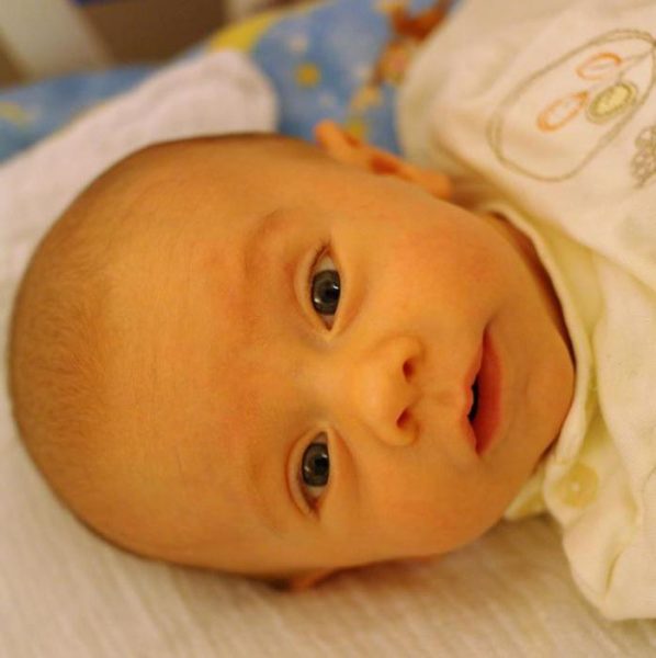 лицо новорождённого с желтухой