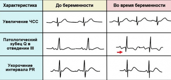 Сравнение кардиограммы до и во время беременности