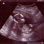 Снимок УЗИ на 4-м месяце беременности