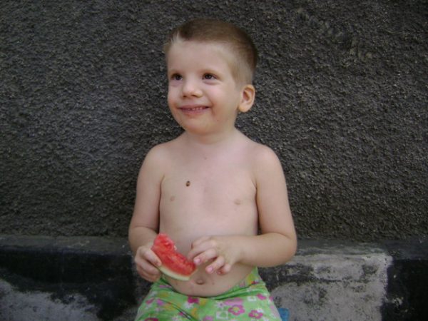 Мальчик с синдромом Эдвардса держит арбуз
