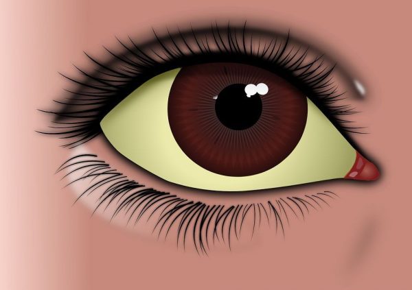 женский глаз с пожелтевшей склерой на схеме