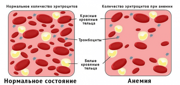 Схема, отражающая количество эритроцитов в нормальном состоянии и при анемии