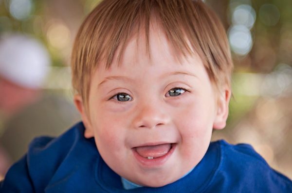 Ребёнок с синдромом Дауна улыбается