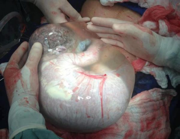 Рождение ребёнка без вскрытия околоплодного пузыря