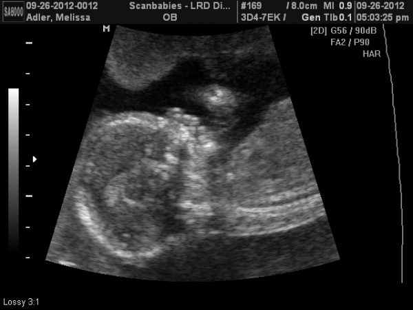 Снимок УЗИ на 22-й неделе беременности