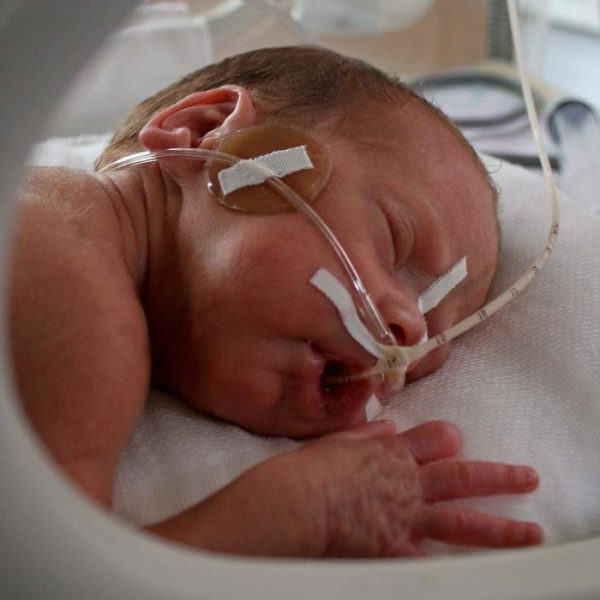 лицо новорождённого с закреплёнными на коже катетерами