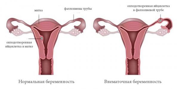Положение оплодотворенной яйцеклетки при нормальной и внематочной беременности
