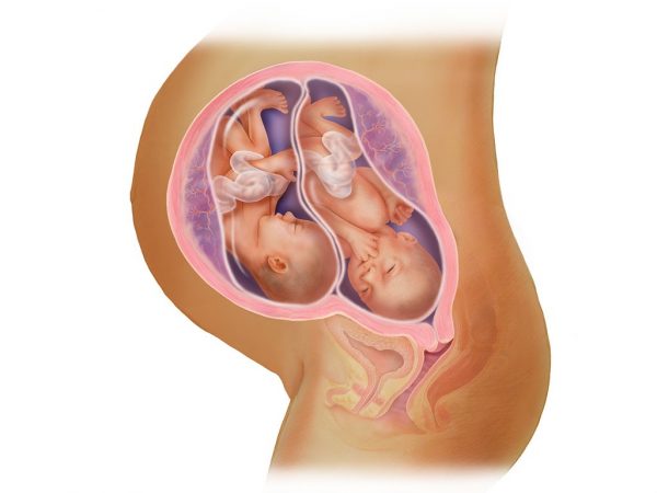 Расположение детей при многоплодной беременности